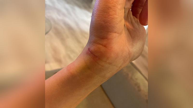 Место вживления чипа на правой руке/ Фото: twitter.com/Halluart